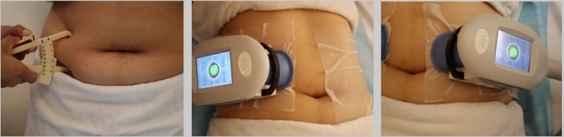 CoolSculpting CoolSculpting