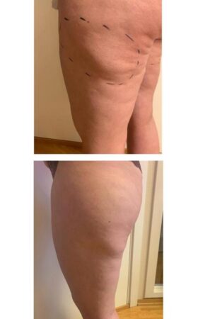 CoolSculpting 1 behandling CoolSculpting 1 behandling