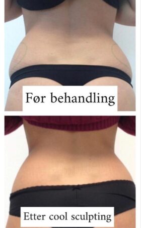 CoolSculpting 2 behandlinger CoolSculpting 2 behandlinger