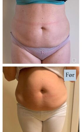 CoolSculpting 2 behandling - 10 uker etter CoolSculpting 2 behandling - 10 uker etter
