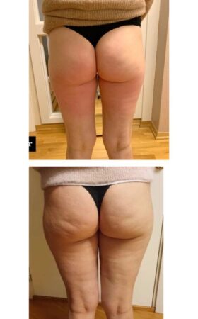 Endermologi Endermologi