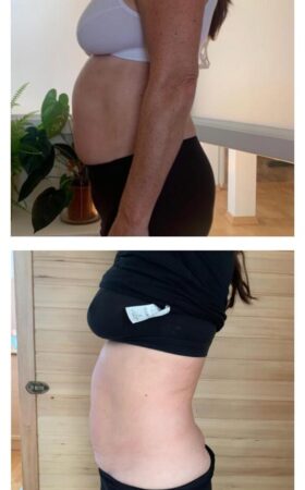 Serie med CoolSculpting Serie med CoolSculpting
