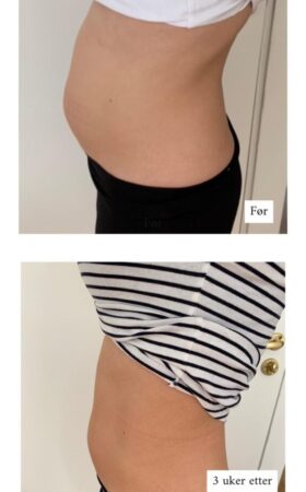 3 uker etter CoolSculpting 3 uker etter CoolSculpting