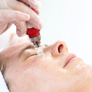 microneedling microneedling