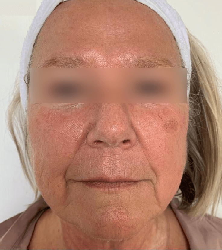 Emface Norge, Em face Oslo, Neo pro face Norge, Neo pro face Oslo, Emface i Norge, Emface Norway kroppsterapi, Ansiktslifting Norge, Ansiktslift Oslo, Ansiktsfornyelse Norge, Ansiktsfornyelse Oslo, Ansiktslift uten skalpell Norge, Ansiktslift uten skalpell Oslo